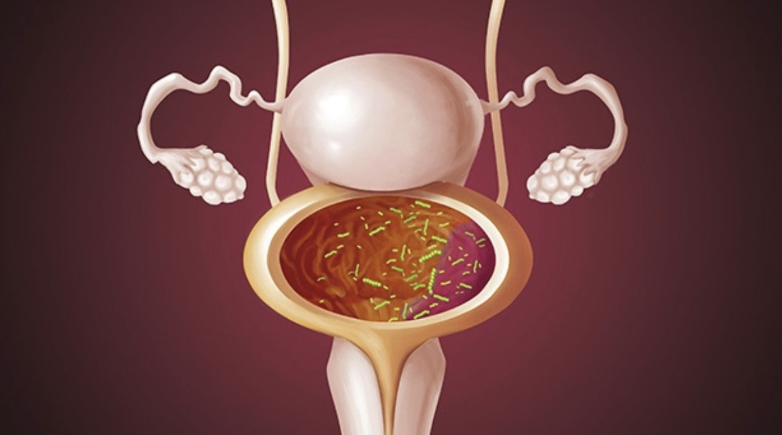 Những yếu tố âm thầm làm tăng nguy cơ viêm bàng quang cấp